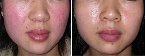 Sensitive skin soothing essential oil